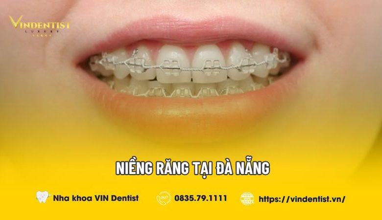 Dịch vụ niềng răng tại Đà Nẵng